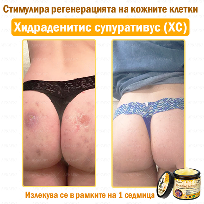 ✨💜💜APKAPK® КРЕМ ЗА ДЪЛБОКО ПОДХРАНВАНЕ НА КОЖАТА 🥇 Обхваща лечението на кожни проблеми като: бръчки, белези, петна, кожни израстъци, мазнини, пъпки, екзема, псориазис, акне и инверсни лезии, рани, кожни раздразнения и други проблеми 🔥