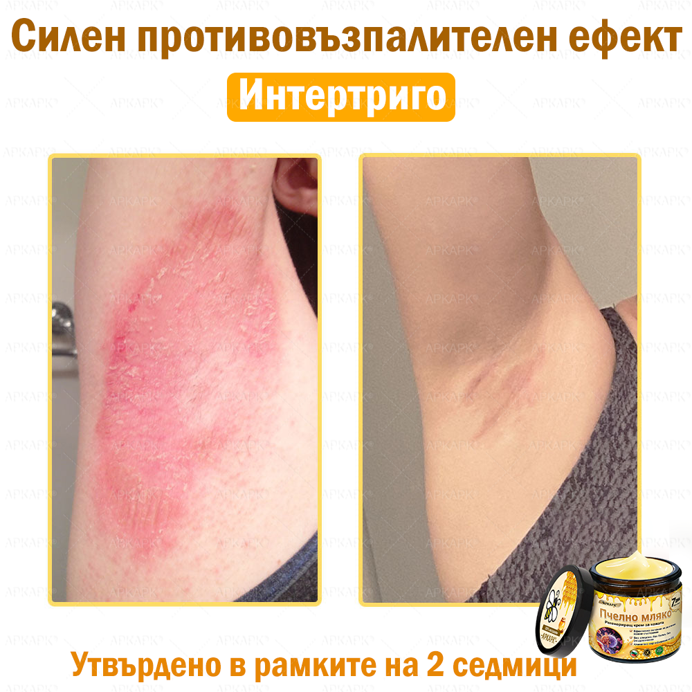 ✨💜💜APKAPK® КРЕМ ЗА ДЪЛБОКО ПОДХРАНВАНЕ НА КОЖАТА 🥇 Обхваща лечението на кожни проблеми като: бръчки, белези, петна, кожни израстъци, мазнини, пъпки, екзема, псориазис, акне и инверсни лезии, рани, кожни раздразнения и други проблеми 🔥
