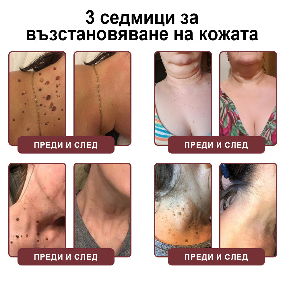 Клинично доказано решение против брадавици👨‍⚕️ZUWIAY® KeraErase Двойно Действие Подмладяващ Крем🔥 Безболезнено и мощно премахва: обикновени брадавици, плантарни брадавици, плоски брадавици, нишковидни брадавици и папиломи.