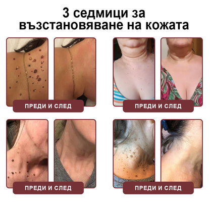 Клинично доказано решение против брадавици👨‍⚕️ZUWIAY® KeraErase Двойно Действие Подмладяващ Крем🔥 Безболезнено и мощно премахва: обикновени брадавици, плантарни брадавици, плоски брадавици, нишковидни брадавици и папиломи.