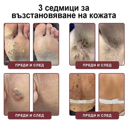 Клинично доказано решение против брадавици👨‍⚕️ZUWIAY® KeraErase Двойно Действие Подмладяващ Крем🔥 Безболезнено и мощно премахва: обикновени брадавици, плантарни брадавици, плоски брадавици, нишковидни брадавици и папиломи.