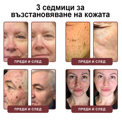 Клинично доказано решение против брадавици👨‍⚕️ZUWIAY® KeraErase Двойно Действие Подмладяващ Крем🔥 Безболезнено и мощно премахва: обикновени брадавици, плантарни брадавици, плоски брадавици, нишковидни брадавици и папиломи.