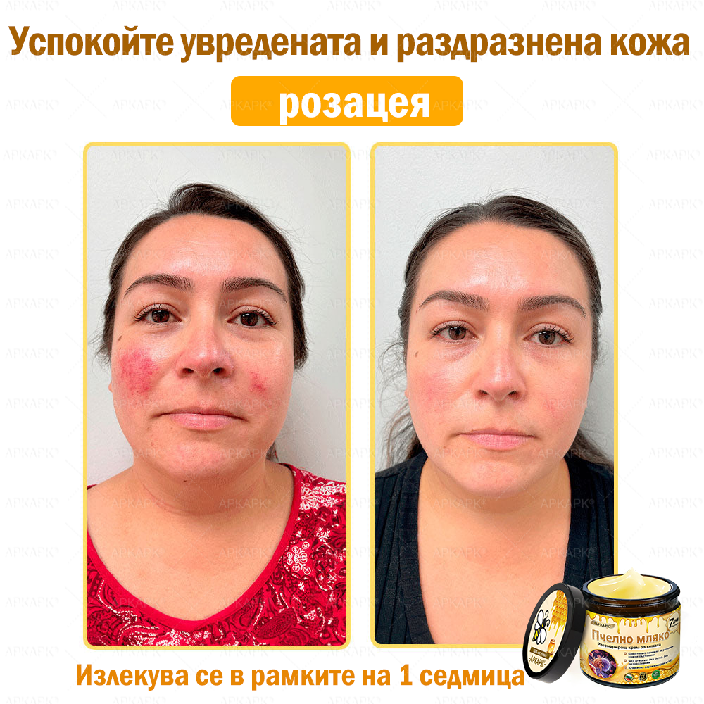 ✨💜💜APKAPK® КРЕМ ЗА ДЪЛБОКО ПОДХРАНВАНЕ НА КОЖАТА 🥇 Обхваща лечението на кожни проблеми като: бръчки, белези, петна, кожни израстъци, мазнини, пъпки, екзема, псориазис, акне и инверсни лезии, рани, кожни раздразнения и други проблеми 🔥